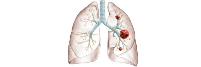 Cancer du poumon a petites cellulles opéré (lobectomie) est-il guerissable ?